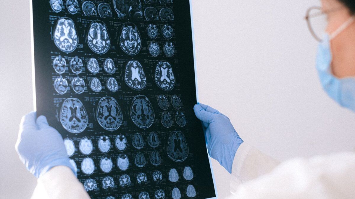 Lilly contorna o Estado: a nova droga para Alzheimer vai para a rede privada