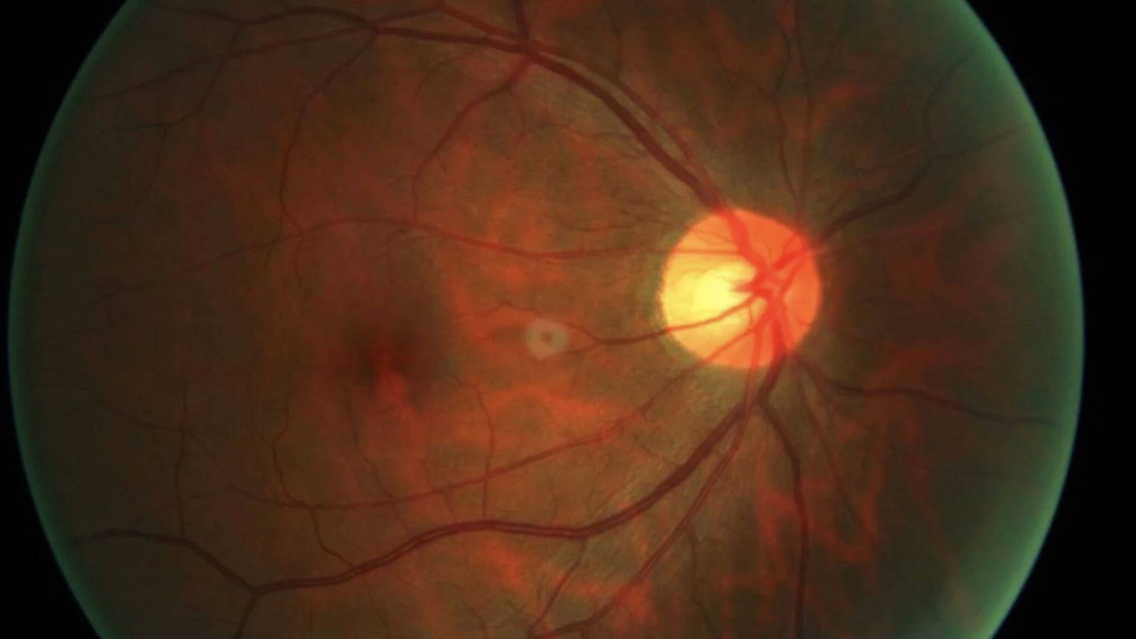 Life Biosciences inicia testes em humanos para reverter envelhecimento ocular