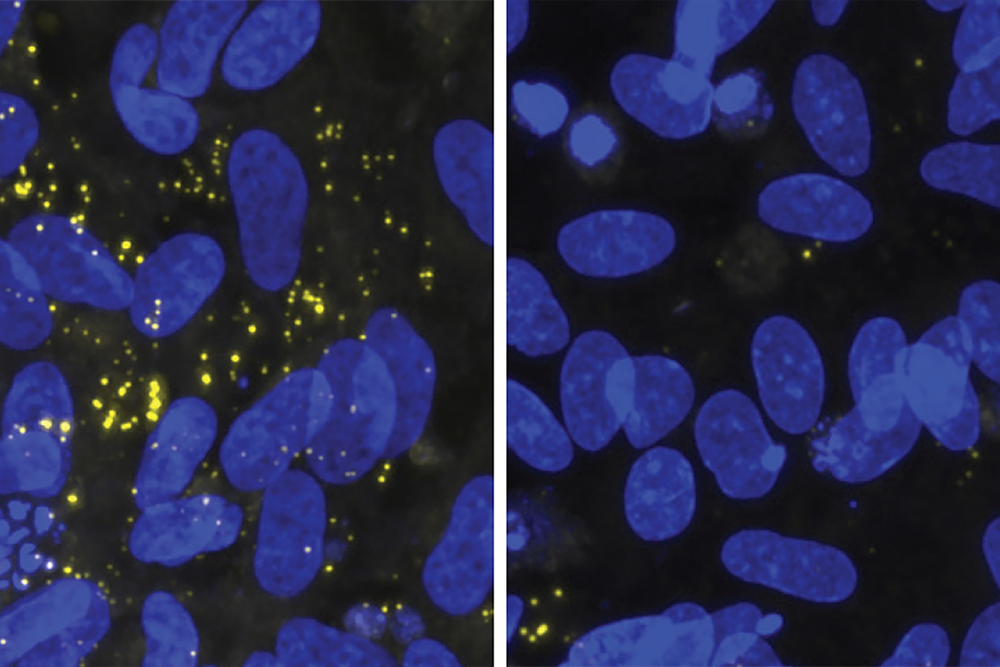 Gene APOE4 sabota mielinização em Alzheimer; MIT aponta via terapêutica