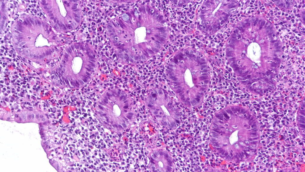 Abivax vê ação despencar após sucesso em eficácia para colite — casos de câncer preocupam
